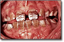  La décoloration des dents - Figure 7