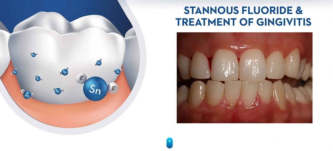 Stannous Fluoride and the Treatment of Gingivitis