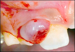 image d’un granulome à cellules géantes périphériques