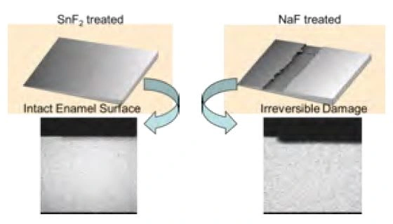 Stannous fluoride vs. sodium fluoride in in vitro treated enamel slabs