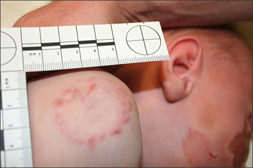 Macro image of the possible bitemark pattern on the shoulder of the child abuse victim.