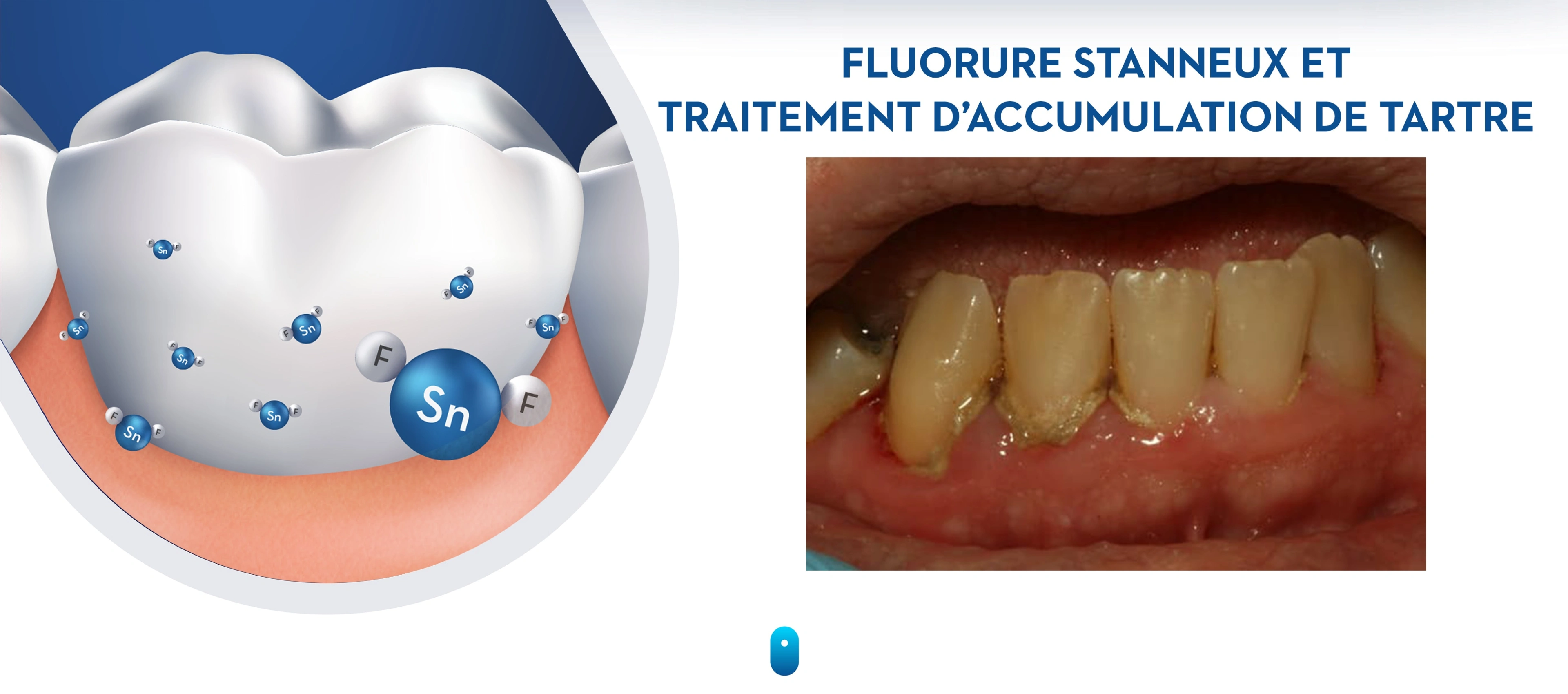 ACTIVITÉ CONTRE L’ACCUMULATION DE TARTRE – ÉTUDE CLINIQUE OFFERTE EN ANGLAIS UNIQUEMENT