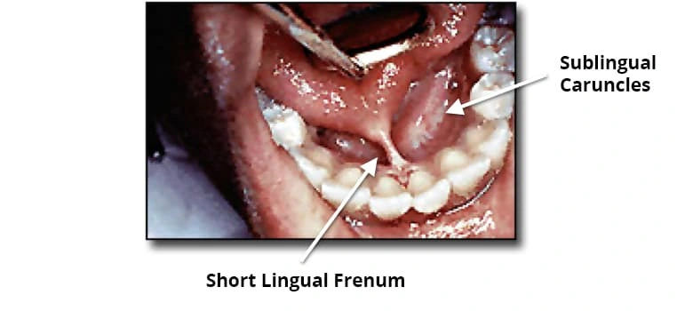 Tongue - Ventral Surface