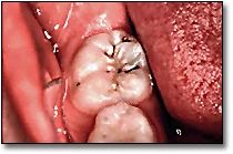  Pit and Fissure Caries