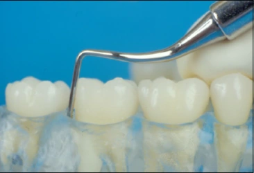 La figure 33 montre une curette Langer 17/18 sur les dents postérieures