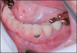 image d’un kyste gingival 