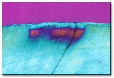 Images illustrant des clichés de micrographie en lumière polarisée (dans l'eau) d'une section unique de lésion de l'émail dans un modèle humain in vivo pour observer la reminéralisation d'une lésion avec l'utilisation d'un traitement au fluorure.