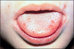 Images de gingivo-stomatite herpétique primaire