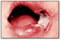Les lésions buccodentaires d’origine électrique - Brûlure cicatrisée de la commissure des lèvres