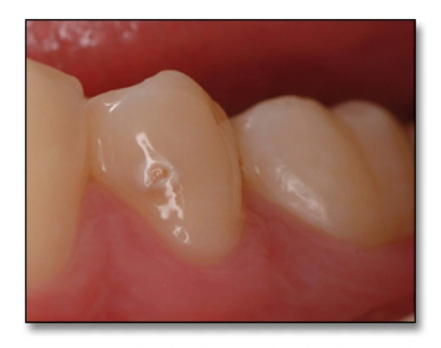 Surfaces at Risk for Caries - Figure 5