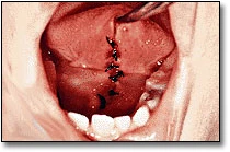 Ankyloglossia - Figure 4