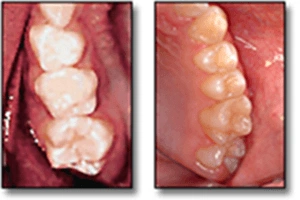 Modèle d’éruption - Dents permanentes - Figure 1