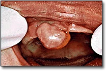 Congenital Epulis of the Newborn - Figure 1