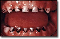 Discolored Teeth - Figure 9