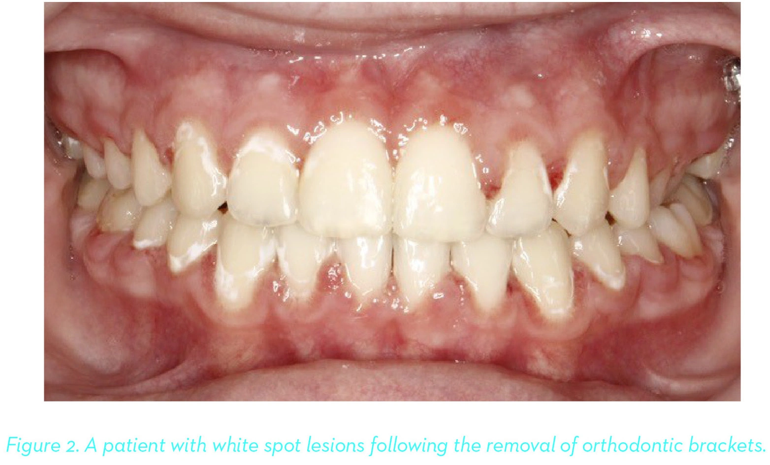 A patient with white spot lesions following the removal of orthodontic brackets