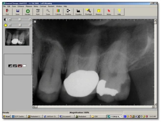 Image illustrant une radiographie périapicale numérique obtenue à l'aide du système Schick.