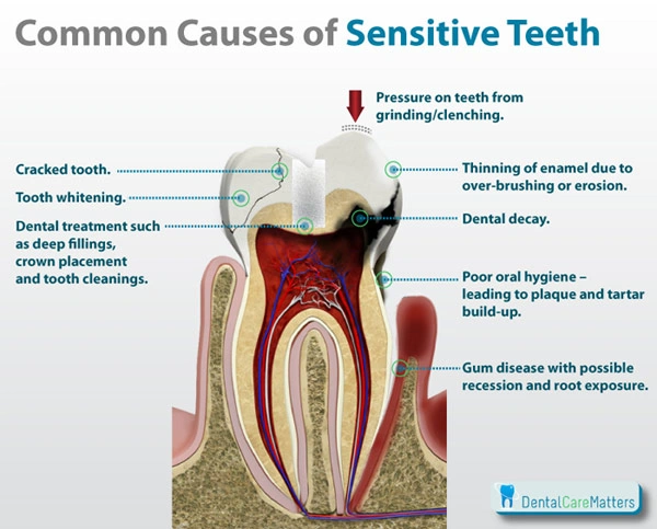 Dientes sensibles: causas y tratamiento