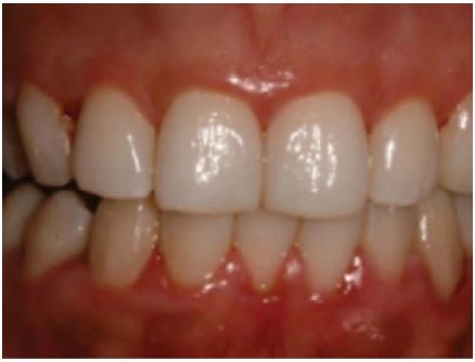 Gingivitis with redness and swelling