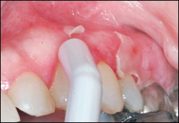 Vesicular-Ulcerated-Erythematous Surface Lesions of Oral Mucosa