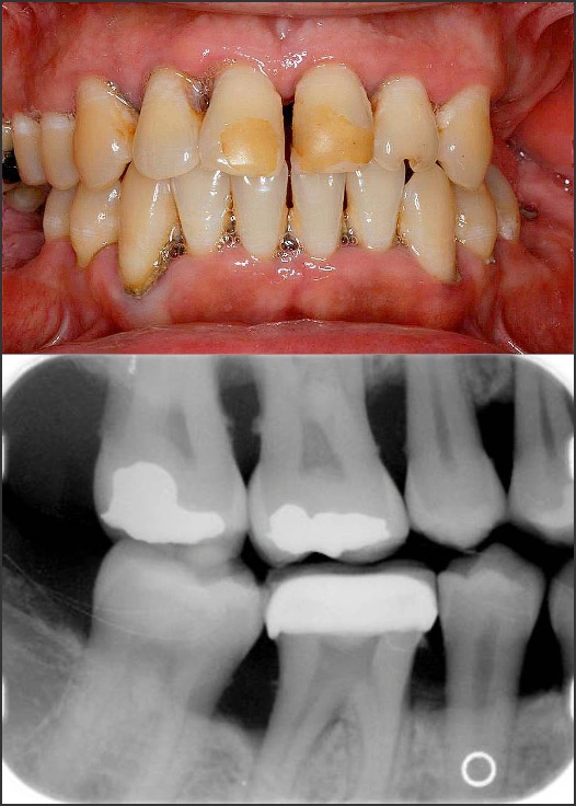 Steps for Determining a Diagnosis of Periodontitis - Figure 3