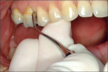 La figure 14 est une photo de la bouche d’un patient sondé avec une curette Gracey 15/16