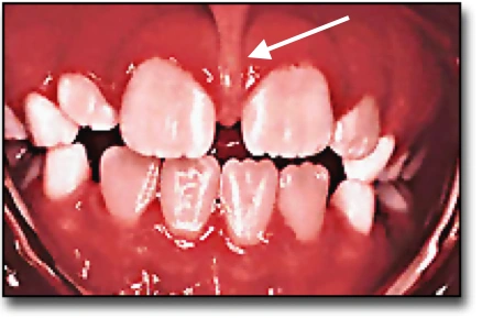 Le diastème - Diastème de la dentition mixte