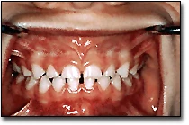 Tooth Form - Primary Teeth