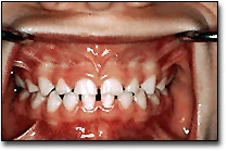 La forme des dents - dents primaires