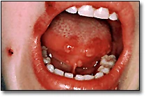 Primary Herpetic Gingivostomatitis - Figure 2