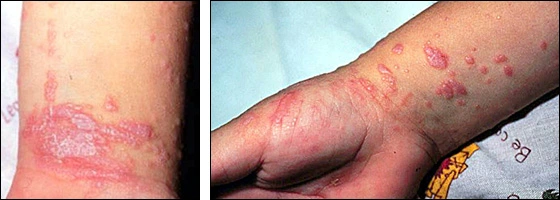 Skin lesions of lichen planus