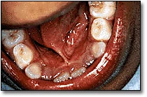 Ankyloglossia