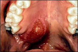 image d’un adénocarcinome de la glande salivaire 
