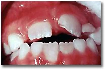 Les fractures dentaires - Figure 1