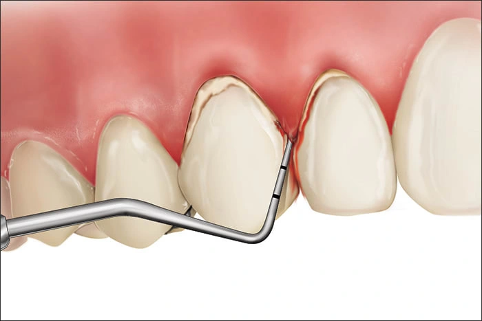 Illustration showing a Code 4 during periodontal probing