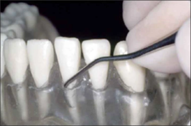 La figure 8 montre un modèle de dents avec des gencives translucides que l’on sonde au moyen d’un instrument dentaire