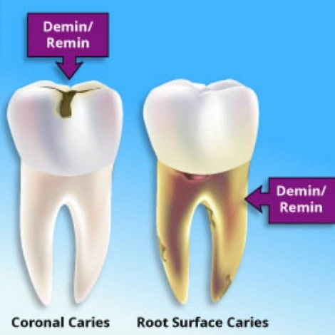 An Update on Demineralization/Remineralization