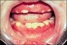 Images de gingivo-stomatite herpétique primaire