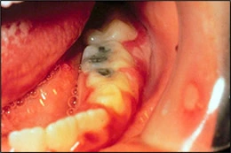 Images de gingivo-stomatite herpétique primaire