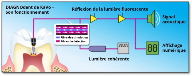 Diagramme illustrant la fonctionnalité du dispositif DIAGNOdent de KaVo.