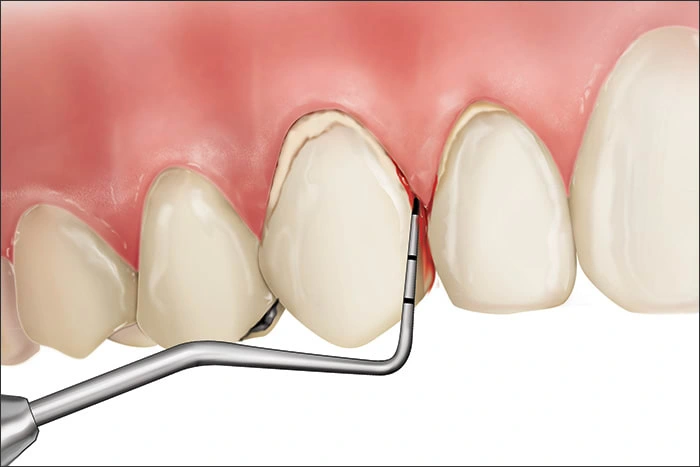 Illustration showing a Code 3 during periodontal probing