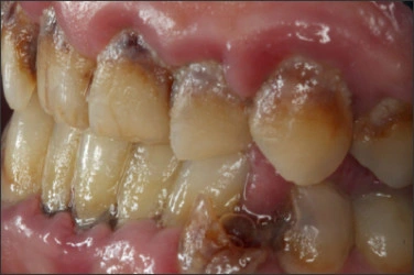 Photo montrant un exemple de caries dentaires