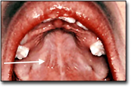 The Palate - Junction of the Hard and Soft Palate
