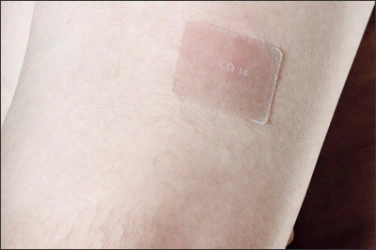 Photo montrant un exemple d’un timbre de nicotine sur le bras