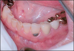 Gingival cyst
