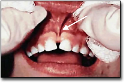 Le diastème - Diastème de la dentition primaire