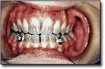 Discolored Teeth - Figure 5