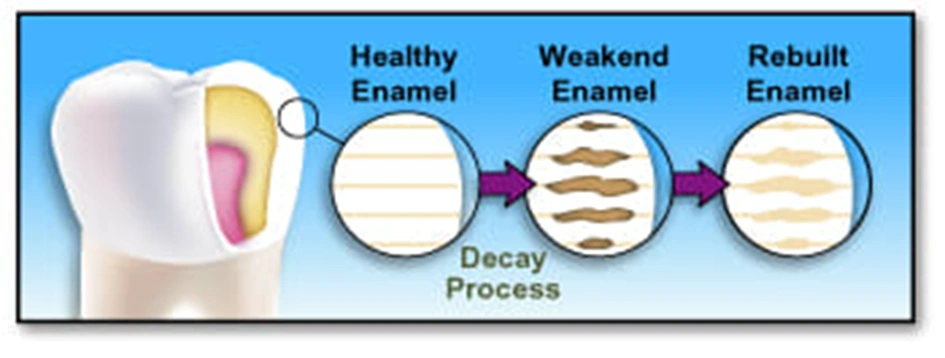 Fluoride and Caries Prevention - Figure 1