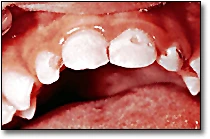 Early Childhood Caries (Patterns of Decay) - Figure 2
