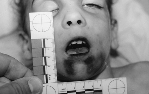 Photo showing burns on the chin and other facial injuries of a child abuse victim