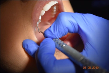 Figure 65 : une photo d’une bouche ouverte montrant la méthode du point d’appui extrabuccal